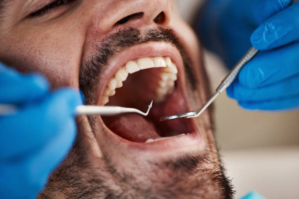 Best Emergency Tooth Extraction in Tladega, AL