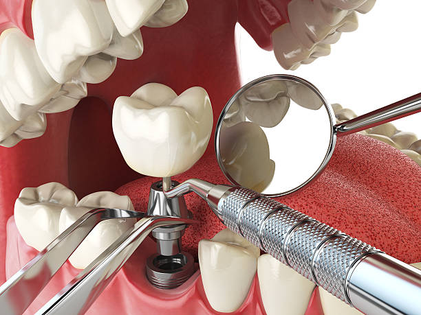 Best Emergency Root Canal Treatment in Tladega, AL
